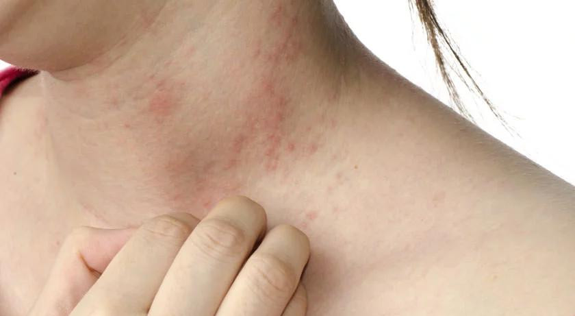 Dermatitis atópica