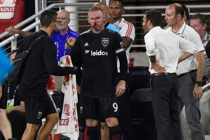 Rooney - MLS accidente