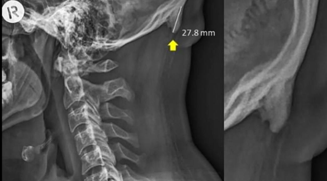 El uso del celular modificó el esqueleto humano