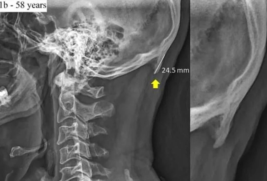 El uso del celular modificó el esqueleto humano