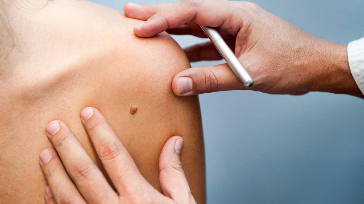 Melanoma, médico, salud, Foto iStock