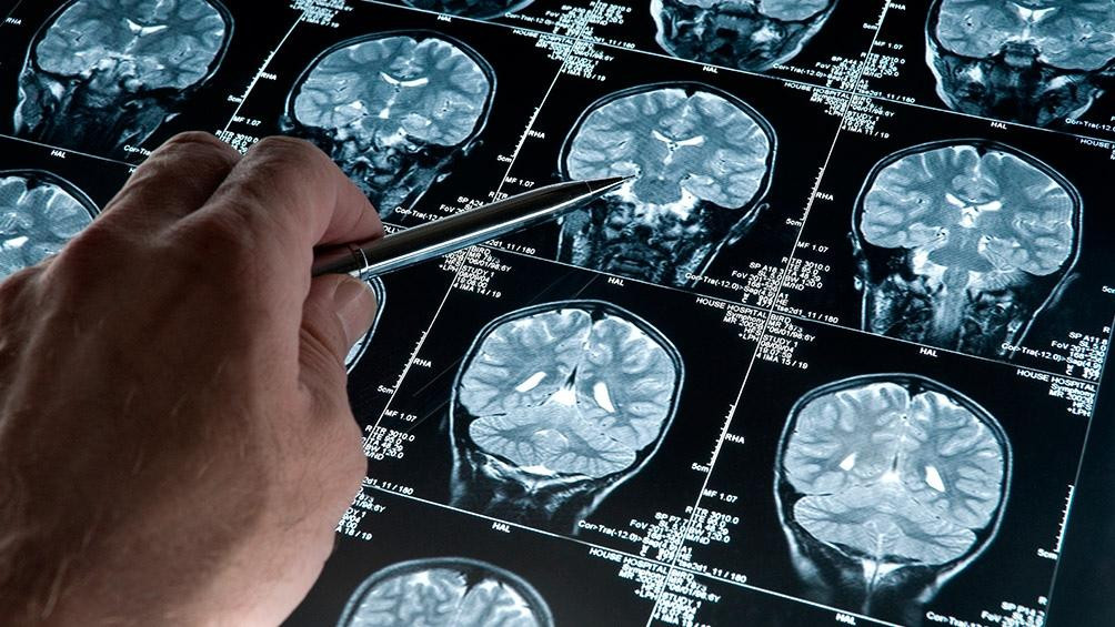 Alzheimer, estudios médicos