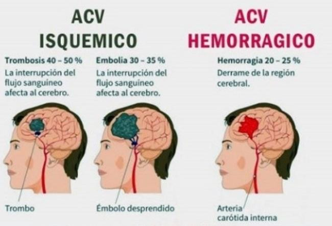 29 de octubre día Mundial del ACV