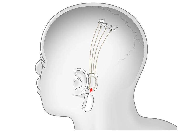 Propuesta de las primeras instalaciones de Neuralink. Foto: Neuralink