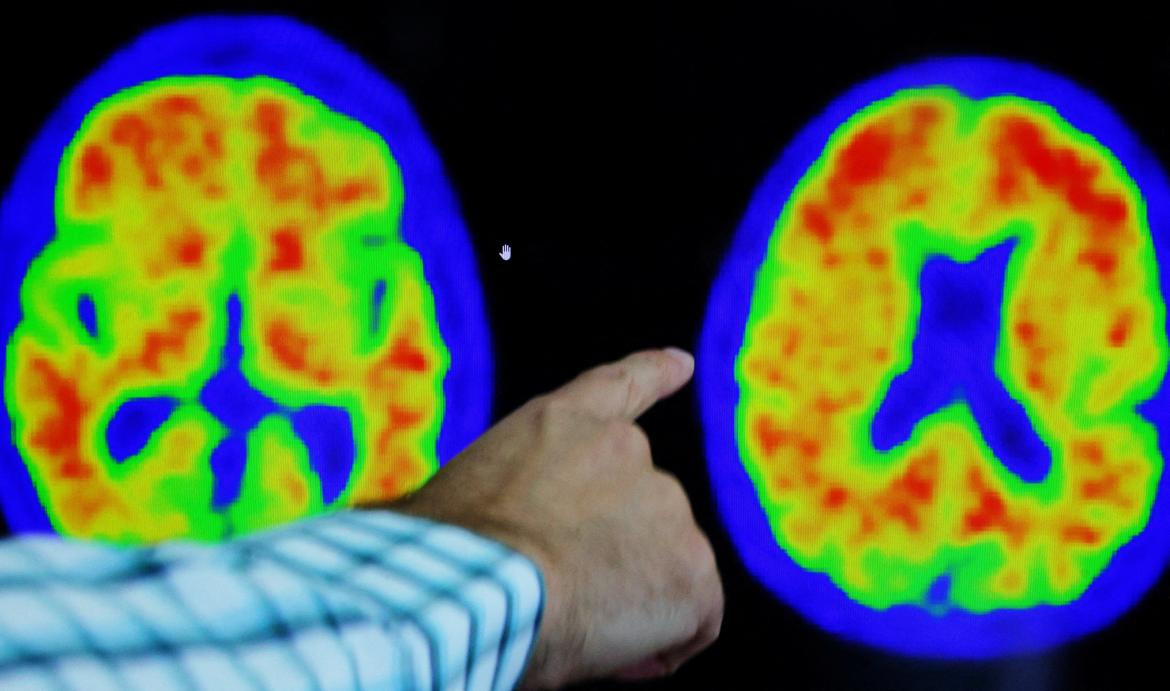 Alzheimer, salud. Foto: Reuters