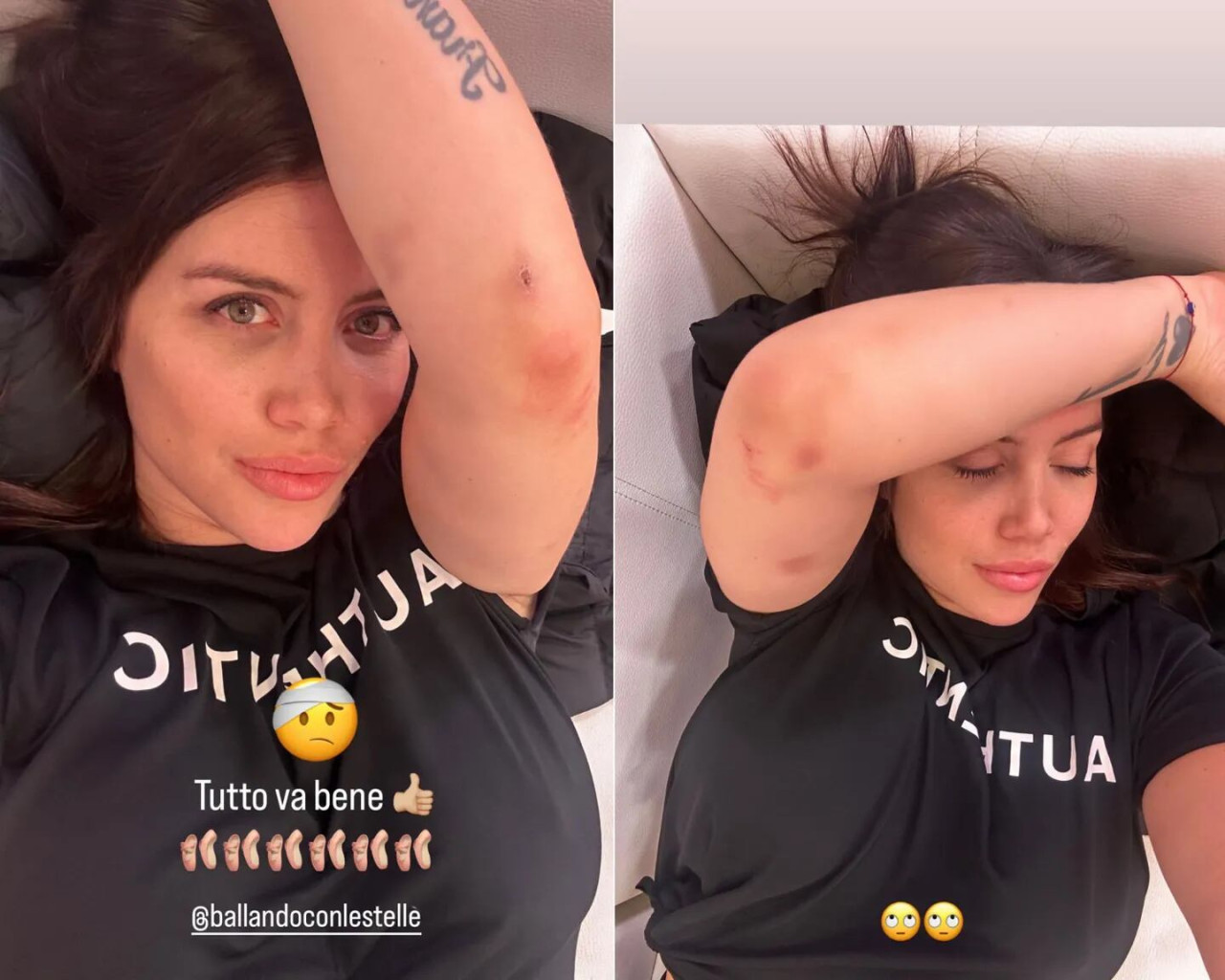 Las imágenes de los golpes que sufrió Wanda Nara. Foto: Instagram.