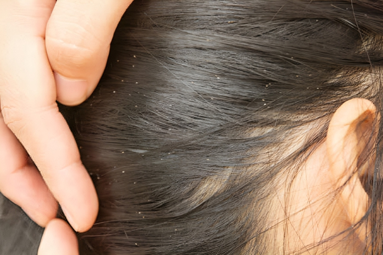 Cabello con caspa. Foto: Unsplash.