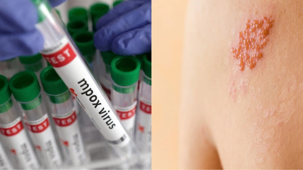 Diferencias entre la viruela del mono y el herpes zóster. Foto: Reuters.