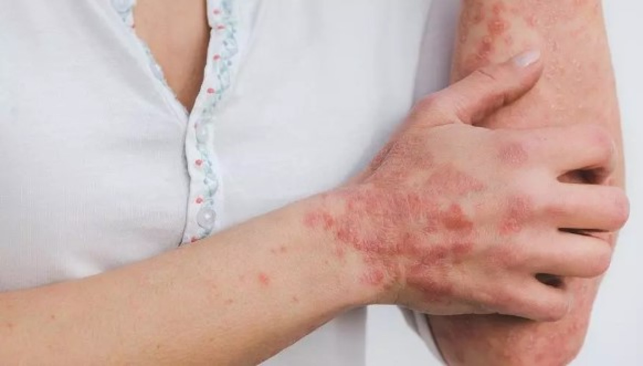 Urticaria crónica. Foto: Freepik