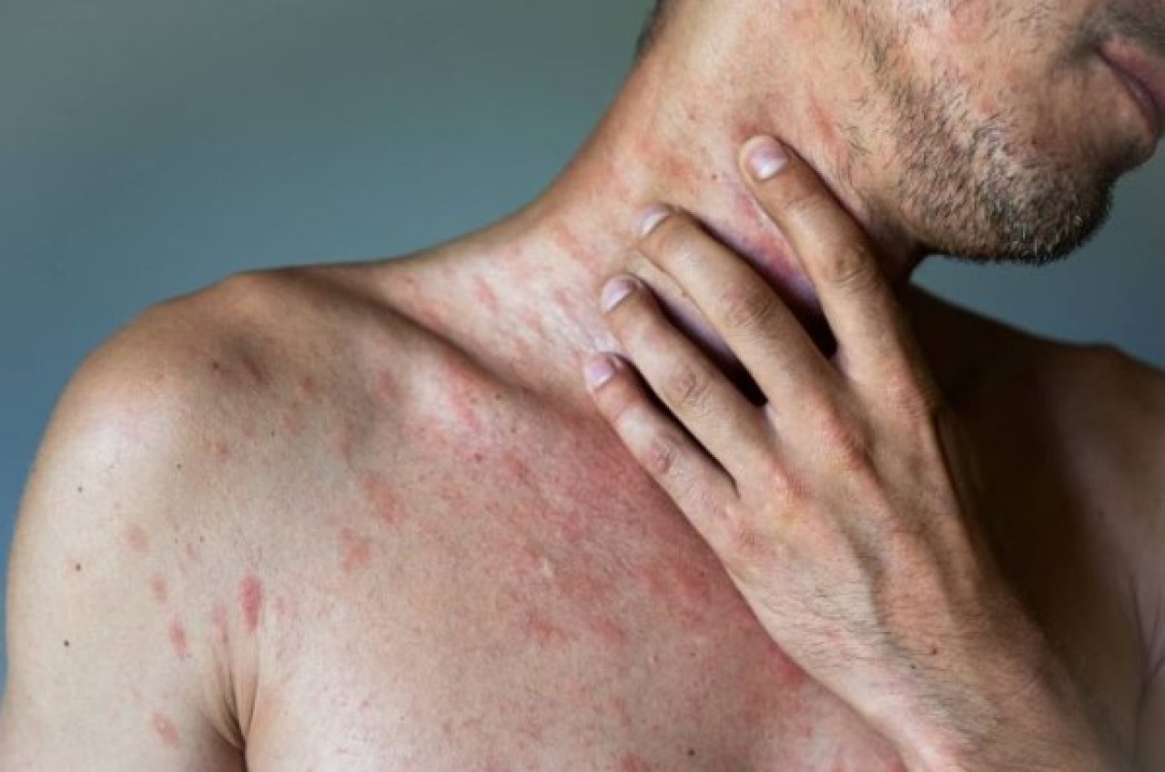 Urticaria crónica. Foto: Medscape