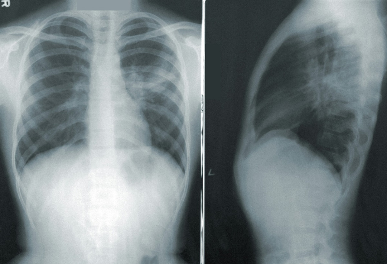 Radiografía de pulmones. Foto: Unsplash.