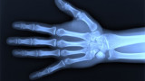 Radiografía de mano
