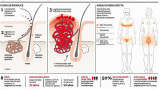 Hidradenitis supurativa (Infografía Clarín)