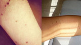 Lunares en el brazo