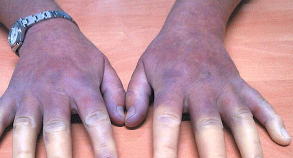 Esclerodermia - Enfermedad de las manos azules