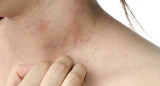 Dermatitis atópica