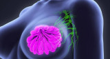 Presentaron un tratamiento que prolonga la vida de mujeres con cáncer de mama