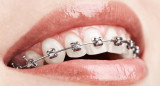 Brackets