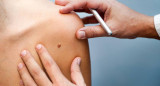 Melanoma, médico, salud, Foto iStock