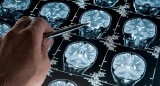 Alzheimer, estudios médicos