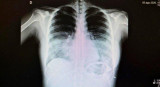 Coronavirus en España, radiografía de pulmones, salud