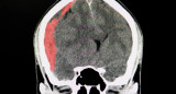 Hematoma subdural crónico, salud