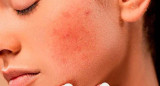 Dermatitis atópica