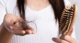 Pelo, caída del pelo, caída del cabello, NA