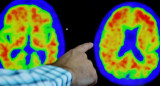 Alzheimer, salud. Foto: Reuters