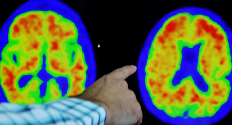 Alzheimer, salud. Foto: Reuters