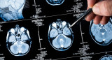 Cáncer de cerebro.