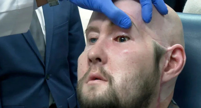 Aaron James, un paciente de 46 años que sobrevivió a una intensa descarga eléctrica por la que perdió su ojo izquierdo. Foto: Twitter