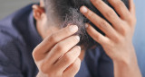 Alopecia, caída de cabello. Foto Unsplash.