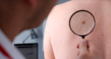 Cáncer de piel. Foto: EFE
