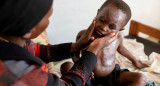 Mpox virus; viruela del mono. Foto: Reuters.